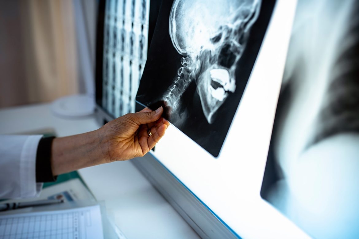 <a href="https://news.harvard.edu/gazette/section/health/">
			Health		</a>
		
		
		A setback to research that offered hope for fibrous dysplasia patients	
			
			Halt to federal funding disrupts study of rare skeletal disease 		
	
	
	
		
			
					
		Heather Denny	
			
			HSDM Communications		
					
		
		
			August 7, 2025		
		
			3 min read		
	
			
		
	
In 2023, the Harvard School of Dental Medicine was awarded a U.S. Department of Defense grant to fund a four-year study of fibrous dysplasia (FD), a severe skeletal disease in which benign tumors cause bone deformities, fractures, and pain. The award aimed to investigate the cellular and molecular underpinnings of the disease, which affects an estimated 1 in 15,000 to 30,000 people and currently has no cure. The research had promise not only for treating FD, but also for finding treatments for conditions affecting military personnel, including blast-induced heterotopic ossification and chronic bone pain.
At the time, the funding was applauded by patients and patient advocacy groups such as FD/MAS Alliance, a nonprofit dedicated to finding evidence-based treatments for Fibrous Dysplasia and McCune-Albright syndrome.
<blockquote>“This funding was more than just a financial award—it was a crucial investment in understanding and eventually treating a devastating disease.”<cite>Adrienne McBride</cite></blockquote>
“This funding was more than just a financial award—it was a crucial investment in understanding and eventually treating a devastating disease,” said Adrienne McBride, executive director of the Alliance. “Advancing research in FD/MAS benefits those living with this rare disease and holds great potential for broader medical applications.”
The mechanisms investigated in FD research have the potential to yield insights relevant for many other diseases causing bone fragility, pain, and fractures. With federal research funding to Harvard now frozen, these insights may never be realized.
“FD patients and their families had been closely following research advances, hoping for novel, effective interventions. The termination of leading-edge projects like this erodes this hope and sends a discouraging signal to those living with an already-overlooked disease,” said Yingzi Yang, professor of Developmental Biology at HSDM, and principal investigator on the grant.
Yingzi Yang.Photo by Steve Gilbert
Yang and her partners at Massachusetts General Hospital (MGH) had been making progress in the few years since the funding was awarded. While some work continues at MGH, the research based in the Yang Lab at HSDM, which was critical to providing a greater understanding of the disease mutation, has stopped.
“We had made substantial progress in terms of identifying potential treatment targets of this devastating disease based on getting a better understanding of the molecular mechanisms,” said Yang. “Cutting off our study disrupts the holistic understanding of the FD disease and reduces the research rigor and impacts.”
<blockquote>“Cutting off our study disrupts the holistic understanding of the FD disease and reduces the research rigor and impacts.”<cite>Yingzi Yang</cite></blockquote>
“The cancellation of this grant is a significant setback for FD/MAS research and for patients, including military personnel, who rely on scientific progress for hope and support,” said McBride.
FD/MAS can affect every bone in the body, but the largest subpopulation of those with the disease are affected by FD lesions in their craniofacial bones, leading to severe facial deformities. 
HSDM alumnus Christopher H. Fox, DMD87, DMSc91, who leads the American Association for Dental, Oral, and Craniofacial Research (AADOCR), also expressed deep concerns over the implications.
“This funding cut of such promising research is a tragedy for the FD/MAS community and indeed for our country.  Through our advocacy efforts, AADOCR is doing everything we can to reverse these ill-advised decisions,” said Fox.