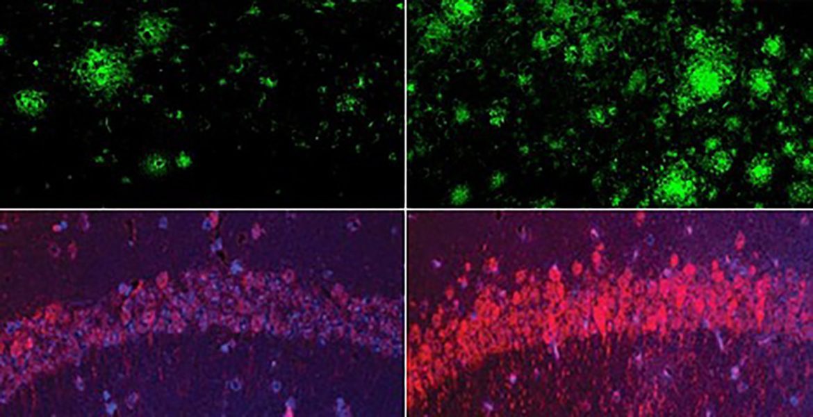 <a href="https://news.harvard.edu/gazette/section/health/">
			Health		</a>
		
		
		Could lithium explain — and treat — Alzheimer’s?	
	
			
		
In a mouse model of Alzheimer’s disease, lithium deficiency (right) dramatically increased amyloid beta deposits in the brain compared with mice that had normal physiological levels of lithium (left). Bottom row: The same was true for the Alzheimer’s neurofibrillary tangle protein tau.Yankner Lab
	
		
			
					
		Stephanie Dutchen	
			
			HMS Communications		
					
		
		
			August 6, 2025		
		
			9 min read		
	
	
			
			Study offers new theory of disease and strategy for fighting it		
		
What is the earliest spark that ignites the memory-robbing march of Alzheimer’s disease? Why do some people with Alzheimer’s-like changes in the brain never go on to develop dementia? These questions have bedeviled neuroscientists for decades.
Now, a team of researchers at Harvard Medical School may have found an answer: lithium deficiency in the brain.
The work, published Wednesday in <a href="https://www.nature.com/articles/s41586-025-09335-x">Nature</a>, shows for the first time that lithium occurs naturally in the brain, shields it from neurodegeneration, and maintains the normal function of all major brain cell types. The findings — 10 years in the making — are based on a series of experiments in mice and on analyses of human brain tissue and blood samples from individuals in various stages of cognitive health.
The scientists found that lithium loss in the human brain is one of the earliest changes leading to Alzheimer’s, while in mice, similar lithium depletion accelerated brain pathology and memory decline. The team further found that reduced lithium levels stemmed from binding to amyloid plaques and impaired uptake in the brain. In a final set of experiments, the team found that a novel lithium compound that avoids capture by amyloid plaques restored memory in mice.
The results unify decades-long observations in patients, providing a new theory of the disease and a new strategy for early diagnosis, prevention, and treatment.
<blockquote>Lithium screening through routine blood tests may one day offer a way to identify at-risk individuals who would benefit from treatment to prevent or delay Alzheimer’s onset.</blockquote>
Affecting an estimated <a href="https://alz-journals.onlinelibrary.wiley.com/doi/10.1002/alz.12694">400 million people</a> worldwide, Alzheimer’s disease involves an array of brain abnormalities — such as clumps of the protein amyloid-beta, neurofibrillary tangles of the protein tau, and <a href="https://hms.harvard.edu/news/aging-brain-needs-rest">loss of a protective protein called REST</a> — but these never explained the full story of the disease. For instance, some people with such abnormalities show no signs of cognitive decline. And recently developed treatments that target amyloid-beta typically don’t reverse memory loss and only modestly reduce the rate of decline.
It’s also clear that genetic and environmental factors affect risk of Alzheimer’s, but scientists haven’t figured out why some people with the same risk factors develop the disease while others don’t.
Lithium, the study authors said, may be a critical missing link.
“The idea that lithium deficiency could be a cause of Alzheimer’s disease is new and suggests a different therapeutic approach,” said senior author <a href="https://yankner.hms.harvard.edu/">Bruce Yankner</a>, professor of genetics and neurology in the Blavatnik Institute at HMS, who in the 1990s was the first to demonstrate that amyloid-beta is toxic.
The study raises hopes that researchers could one day use lithium to treat the disease in its entirety rather than focusing on a single facet such as amyloid-beta or tau, he said.
One of the main discoveries in the study is that as amyloid-beta begins to form deposits in the early stages of dementia in both humans and mouse models, it binds to lithium, reducing lithium’s function in the brain. The lower lithium levels affect all major brain-cell types and, in mice, give rise to changes recapitulating Alzheimer’s disease, including memory loss.
The authors identified a class of lithium compounds that can evade capture by amyloid-beta. Treating mice with the most potent amyloid-evading compound, called lithium orotate, reversed Alzheimer’s disease pathology, prevented brain-cell damage, and restored memory.
Treating mice with the amyloid-evading lithium orotate (top) reduced amyloid beta (left) and tau (right) much more effectively than lithium carbonate (bottom).Yankner Lab
Although the findings need to be confirmed in humans through clinical trials, they suggest that measuring lithium levels could help screen for early Alzheimer’s. Moreover, the findings point to the importance of testing amyloid-evading lithium compounds for treatment or prevention.
Other lithium compounds are already used to treat bipolar disorder and major depressive disorder, but they are given at much higher concentrations that can be toxic, especially to older people. Yankner’s team found that lithium orotate is effective at one-thousandth that dose — enough to mimic the natural level of lithium in the brain. Mice treated for nearly their entire adult lives showed no evidence of toxicity.
“You have to be careful about extrapolating from mouse models, and you never know until you try it in a controlled human clinical trial,” Yankner said. “But so far the results are very encouraging.”
Lithium depletion is an early sign of Alzheimer’s
Yankner became interested in lithium while using it to study the neuroprotective protein REST. Discovering whether lithium is found in the human brain and whether its levels change as neurodegeneration develops and progresses, however, required access to brain tissue, which generally can’t be accessed in living people.
So the lab partnered with the <a href="https://www.rushu.rush.edu/research-rush-university/departmental-research/rush-alzheimers-disease-center/rush-alzheimers-disease-center-research/epidemiologic-research/memory-aging-project">Rush Memory and Aging Project</a> in Chicago, which has a bank of postmortem brain tissue donated by thousands of study participants across the full spectrum of cognitive health and disease.
Having that range was critical because trying to study the brain in the late stages of Alzheimer’s is like looking at a battlefield after a war, said Yankner; there’s a lot of damage and it’s hard to tell how it all started. But in the early stages, “before the brain is badly damaged, you can get important clues,” he said.
Led by first author <a href="https://connects.catalyst.harvard.edu/Profiles/display/Person/92893">Liviu Aron</a>, senior research associate in the Yankner Lab, the team used an advanced type of mass spectroscopy to measure trace levels of about 30 different metals in the brains and blood of cognitively healthy people, those in an early stage of dementia called mild cognitive impairment, and those with advanced Alzheimer’s.
Lithium was the only metal that had markedly different levels across groups and changed at the earliest stages of memory loss. Its levels were high in the cognitively healthy donors but greatly diminished in those with mild impairment or full-blown Alzheimer’s.
Lithium (upper left) was the only metal that differed significantly between people with and without mild cognitive impairment, often a precursor to Alzheimer’s.
The team replicated the findings in samples obtained from multiple brain banks nationwide.
The observation aligned with previous population studies showing that higher lithium levels in the environment, including in drinking water, tracked with lower rates of dementia.
But the new study went beyond by directly observing lithium in the brains of people who hadn’t received lithium as a treatment, establishing a range that constitutes normal levels, and demonstrating that lithium plays an essential role in brain physiology.
“Lithium turns out to be like other nutrients we get from the environment, such as iron and vitamin C,” Yankner said. “It’s the first time anyone’s shown that lithium exists at a natural level that’s biologically meaningful without giving it as a drug.”
Then Yankner and colleagues took things a step further. They demonstrated in mice that lithium depletion isn’t merely linked to Alzheimer’s disease — it helps drive it.
Loss of lithium causes the range of Alzheimer’s-related changes
The researchers found that feeding healthy mice a lithium-restricted diet brought their brain lithium levels down to a level similar to that in patients with Alzheimer’s disease. This appeared to accelerate the aging process, giving rise to brain inflammation, loss of synaptic connections between neurons, and cognitive decline.
In Alzheimer’s mouse models, depleted lithium dramatically accelerated the formation of amyloid-beta plaques and structures that resemble neurofibrillary tangles. Lithium depletion also activated inflammatory cells in the brain called microglia, impairing their ability to degrade amyloid; caused the loss of synapses, axons, and neuron-protecting myelin; and accelerated cognitive decline and memory loss — all hallmarks of Alzheimer’s disease.
The mouse experiments further revealed that lithium altered the activity of genes known to raise or lower the risk of Alzheimer’s, including the best-known, APOE.
Lithium deficiency thinned the myelin that coats neurons (right) compared to normal mice (left).Yankner Lab
Replenishing lithium by giving the mice lithium orotate in their water reversed the disease-related damage and restored memory function, even in older mice with advanced disease. Notably, maintaining stable lithium levels in early life prevented Alzheimer’s onset — a finding that confirmed that lithium fuels the disease process.
“What impresses me the most about lithium is the widespread effect it has on the various manifestations of Alzheimer’s. I really have not seen anything quite like it all my years of working on this disease,” said Yankner.
A promising avenue for Alzheimer’s treatment
A few limited clinical trials of lithium for Alzheimer’s disease have shown some efficacy, but the lithium compounds they used — such as the clinical standard, lithium carbonate — can be toxic to aging people at the high doses normally used in the clinic.
The new research explains why: Amyloid-beta was sequestering these other lithium compounds before they could work. Yankner and colleagues found lithium orotate by developing a screening platform that searches a library of compounds for those that might bypass amyloid-beta. Other researchers can now use the platform to seek additional amyloid-evading lithium compounds that might be even more effective.
“One of the most galvanizing findings for us was that there were profound effects at this exquisitely low dose,” Yankner said.
If replicated in further studies, the researchers say lithium screening through routine blood tests may one day offer a way to identify at-risk individuals who would benefit from treatment to prevent or delay Alzheimer’s onset.
Studying lithium levels in people who are resistant to Alzheimer’s as they age might help scientists establish a target level that they could help patients maintain to prevent onset of the disease, Yankner said.
Since lithium has not yet been shown to be safe or effective in protecting against neurodegeneration in humans, Yankner emphasizes that people should not take lithium compounds on their own. But he expressed cautious optimism that lithium orotate or a similar compound will move forward into clinical trials in the near future and could ultimately change the story of Alzheimer’s treatment.
“My hope is that lithium will do something more fundamental than anti-amyloid or anti-tau therapies, not just lessening but reversing cognitive decline and improving patients’ lives,” he said.
This research was supported by the National Institutes of Health.